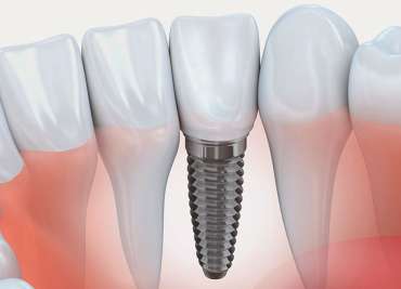 Implante Dentário