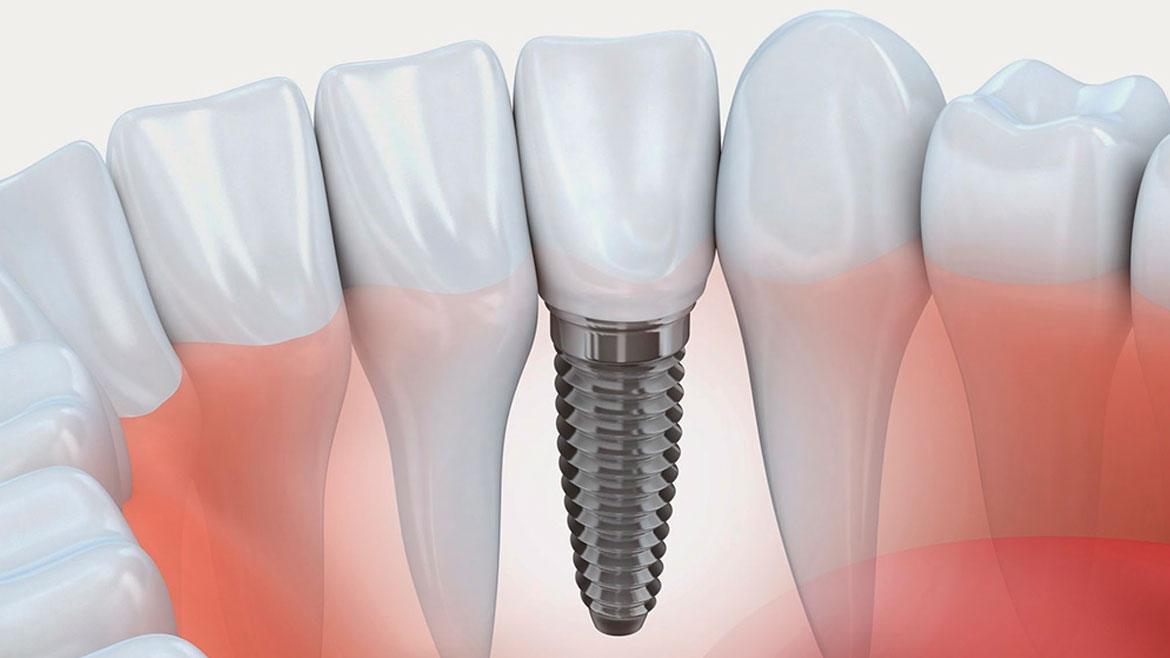 Implante Dentário